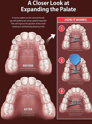 palatal expander